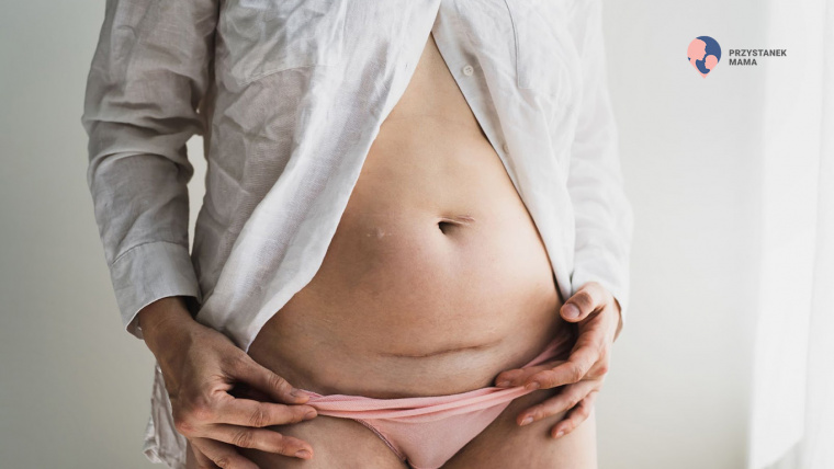 Czy poród przez cesarskie cięcie powoduje większe ryzyko depresji poporodowej?